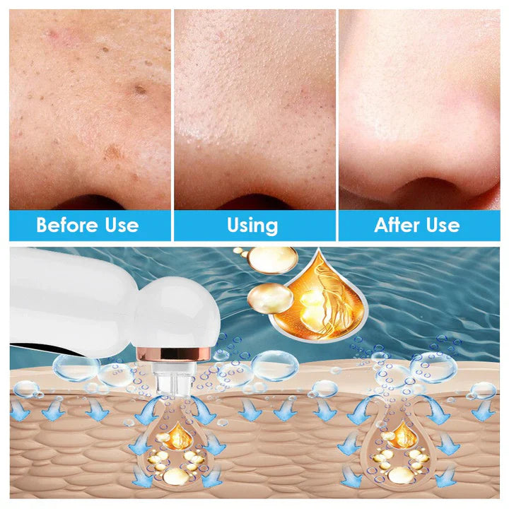 "Hydrodermabrasion Gerät für sanfte Mitesserentfernung und Porenreinigung, kompakt und tragbar, ideal für alle Hauttypen."