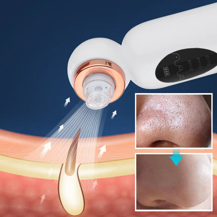 "Hydrodermabrasion Gerät für sanfte Mitesserentfernung und Porenreinigung, kompakt und tragbar, ideal für alle Hauttypen."