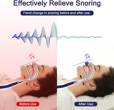 "Kompaktes Micro CPAP-Gerät aus Silikagel, tragbar, USB-aufladbar, ideal zur Schnarchreduktion und für Reisen geeignet."